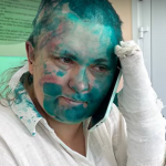Elena Milashina seduta sul letto di un ospedale. La mano sinistra è fasciata e appoggiata al volto. Il visto e la testa sono colorati di blu per via del disinfettante.